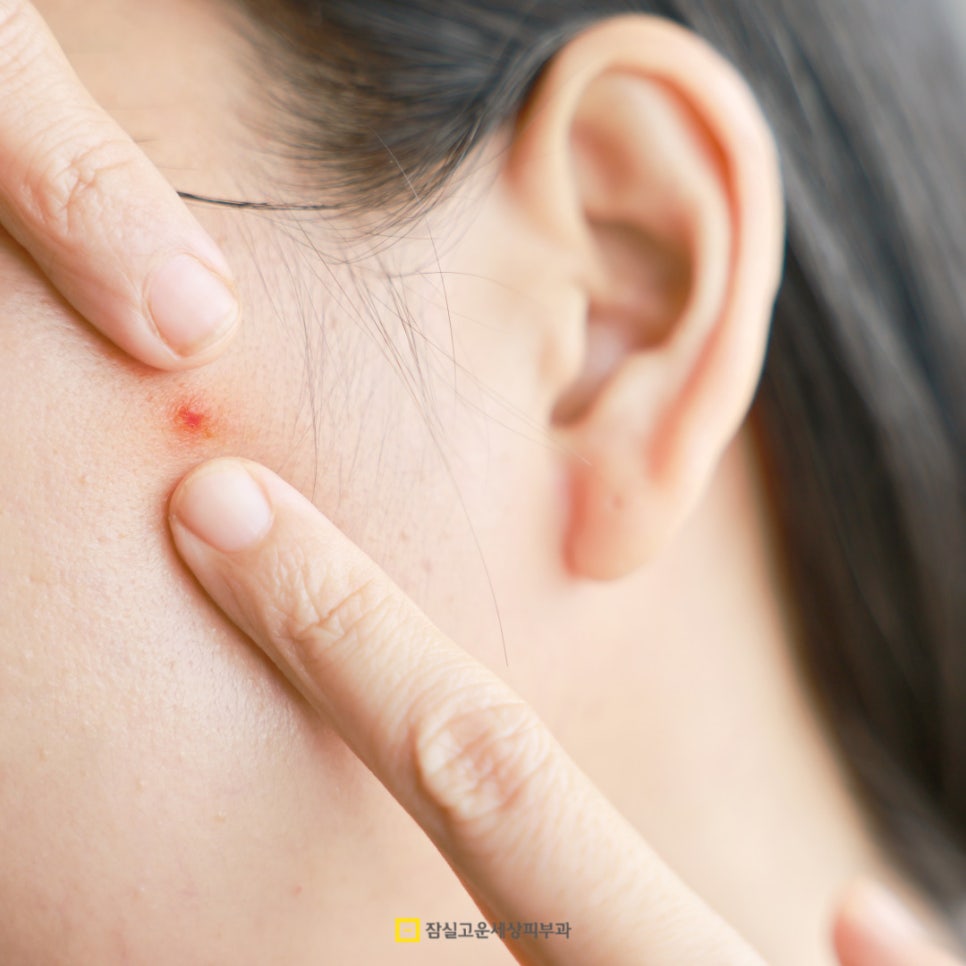 뾰루지 A to Z, 함부로 짜지 말고 제대로 구별하고 케어하세요! 관련 이미지 7