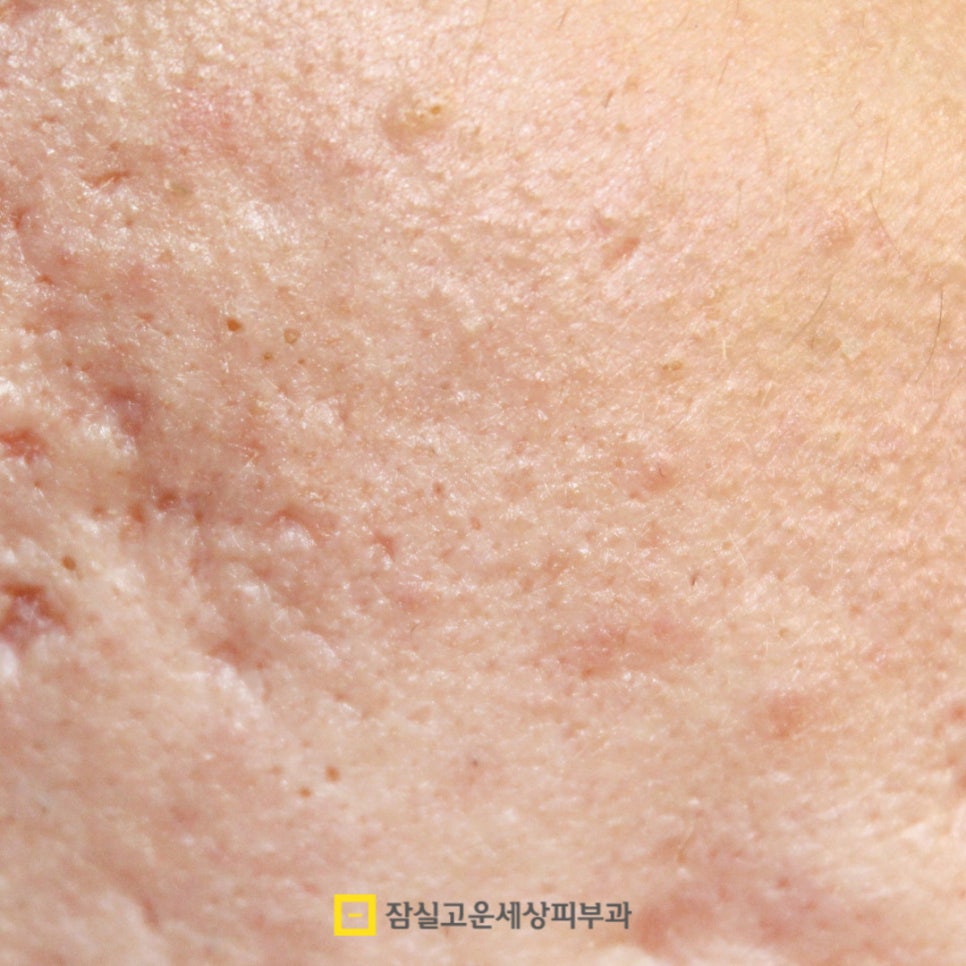 여드름, 왜 흉터로 남을까? 그리고 어떻게 예방할까? 관련 이미지 2