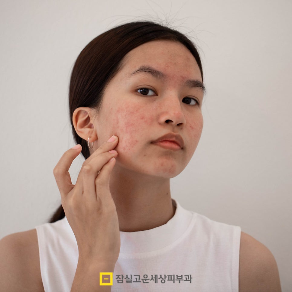 우리 아이 사춘기 여드름, 언제부터 어떻게 관리해야 할까? 관련 이미지 2