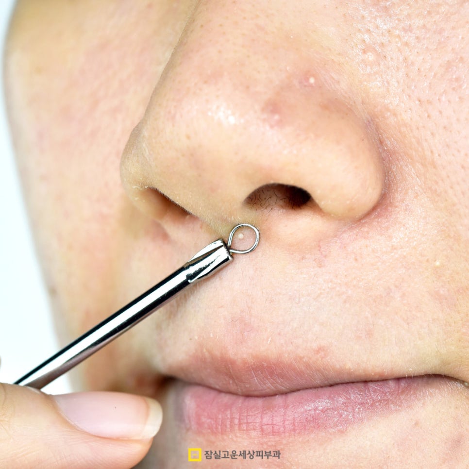 여드름, 이렇게 관리하세요! 관련 이미지 6