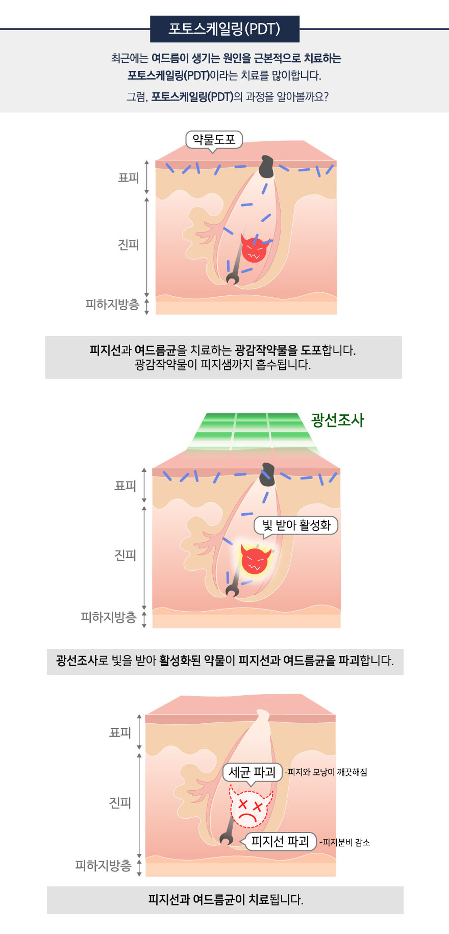[잠실역피부과] 잠실고운세상피부과, 자꾸 재발하는 여드름 치료방법은? 관련 이미지 4