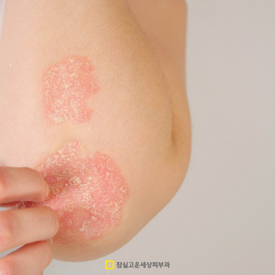 반복되는 하얀 각질과 붉은 반점, 건선일 수 있어요 관련 이미지 7