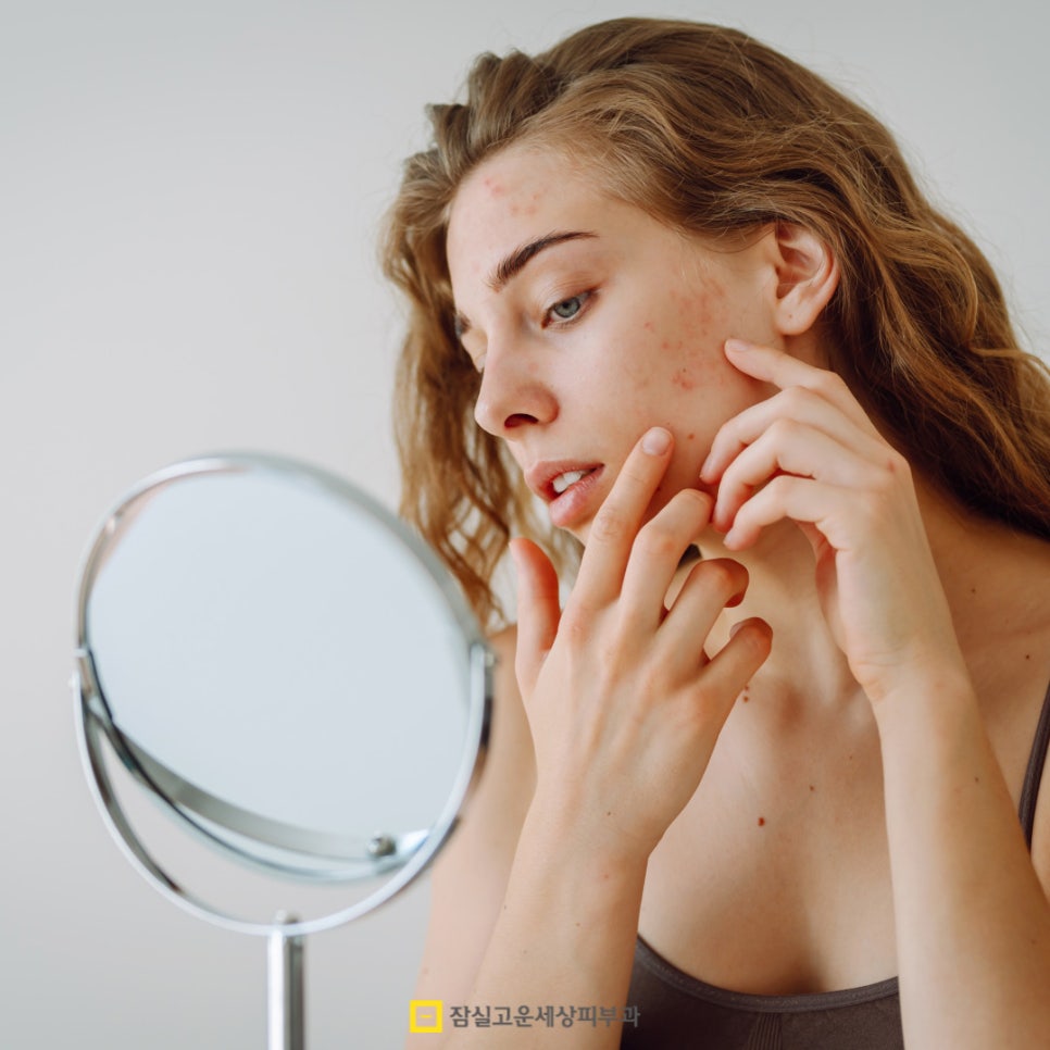 여드름, 반복되는 고민에서 벗어나려면? 관련 이미지 5