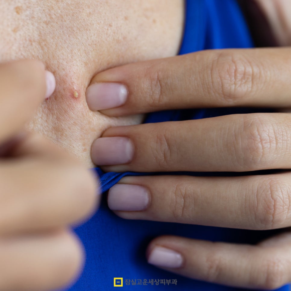 여름철 등드름과 가드름 완전 정복! 시원한 옷차림을 위한 완벽 가이드 관련 이미지 9