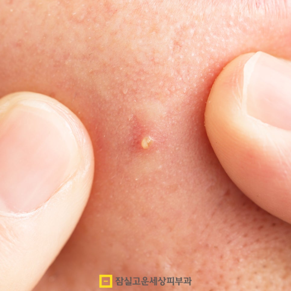 여드름 패치, 상황에 맞게 제대로 쓰는 법 관련 이미지 4