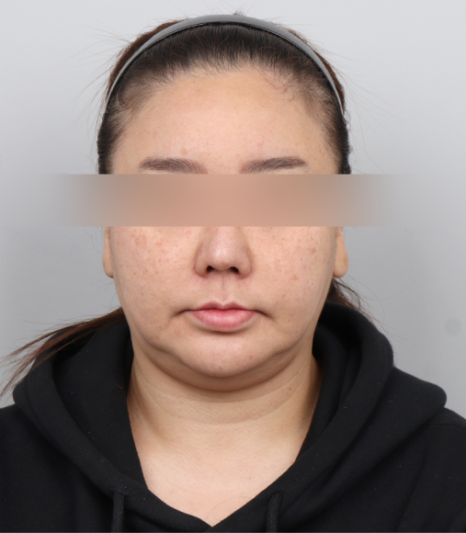이중턱살없애는법? 리프팅 시술 10번 받아봤지만 효과 없었다면 이 글을 보세요 관련 이미지 3