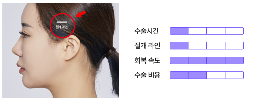 팔자주름수술 필러로는 부족할 때 미니리프팅가격도 체크해보세요 관련 이미지 13