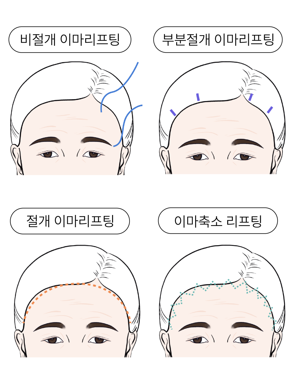 신사이마리프팅으로 달라지는 동안 한끗, 리프팅성형외과 전문의가 밝히는 결정적 차이 관련 이미지 6