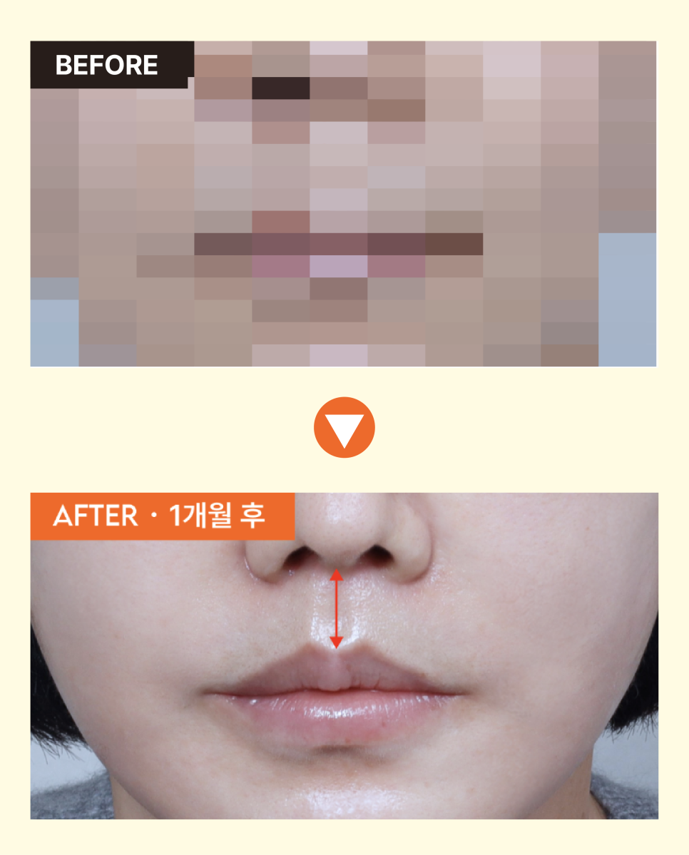 A Review of Upper Lip Reduction Surgery for a Long-Looking Face, and the Aesthetics of Midface Harmony Seen Through Facial Proportions image 7