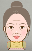 In Apgujeong plastic surgery, is revision lifting essential once the facelift maintenance period has passed? image 8