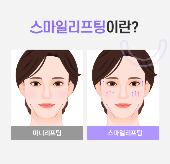 강남미니거상, 왜 안면거상성형외과에서도 주목할까? 관련 이미지 11