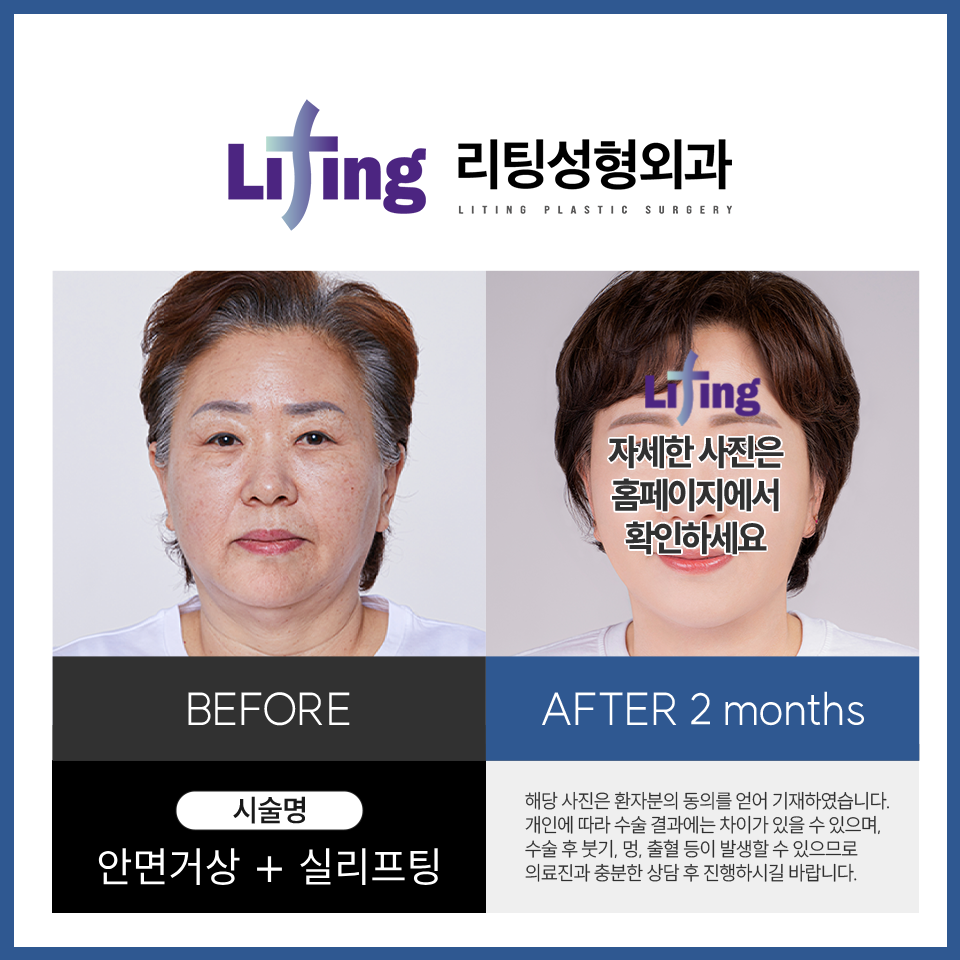 If You’re Worried About Facelift Side Effects image 4