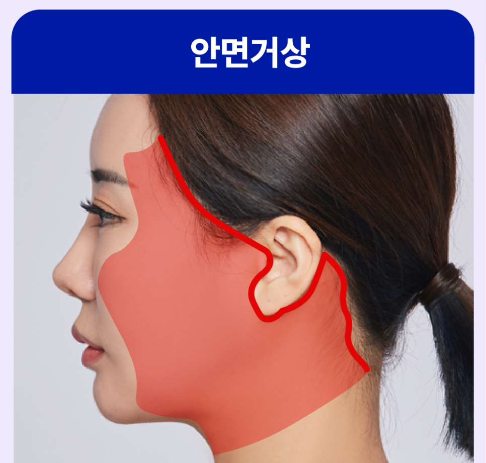 Shinsa Mini Lift, Lifting Plastic Surgery Clinic: Clear Answers to Frequently Asked Questions About Smile Lifting! image 10