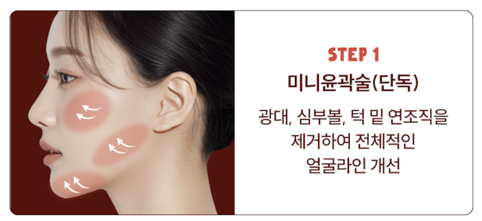 심부볼제거와 안면윤곽수술, 얼굴의 흐름을 디자인하는 리팅성형외과 서울점 또 다른 방법 관련 이미지 9