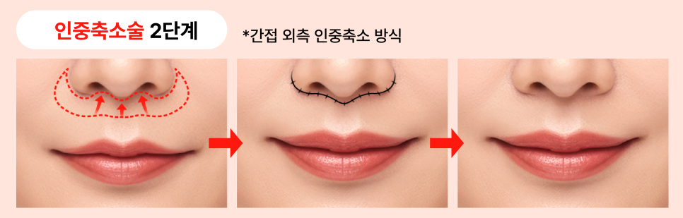 인중축소술로 보는 동안얼굴관리 &mdash; 비율 중심의 의학적 접근 관련 이미지 13