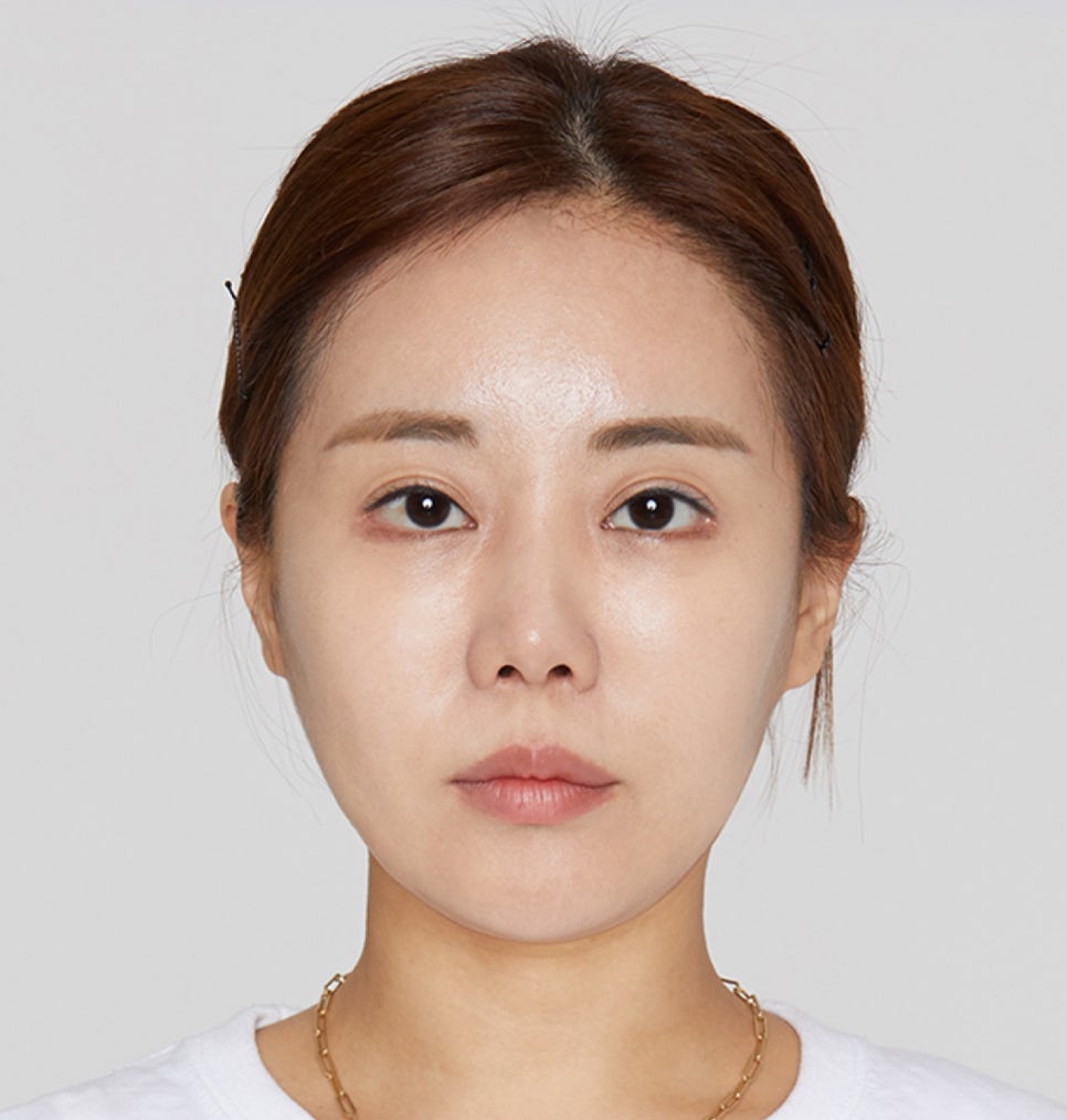 미니리프팅 부작용 피하기 위한 <체크사항> 관련 이미지 5