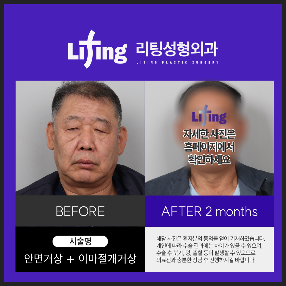 남자안면거상? 첫 시도에 성공하려면 <필독> 관련 이미지 7
