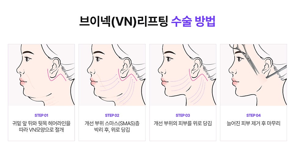 Everything You Need to Know About Facelift Longevity image 7