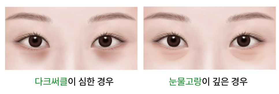 Sinsa Under-Eye Fat Repositioning: A Guide to Natural Under-Eye Changes from a Sinsa Lifting Dermatology Clinic image 6