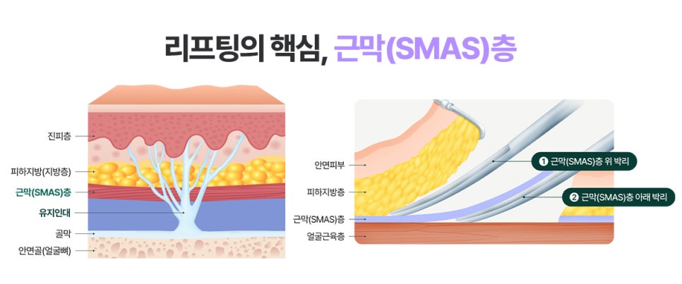 리팅 미니리프팅 맞춤형 노화솔루션 필요한 이유 관련 이미지 6