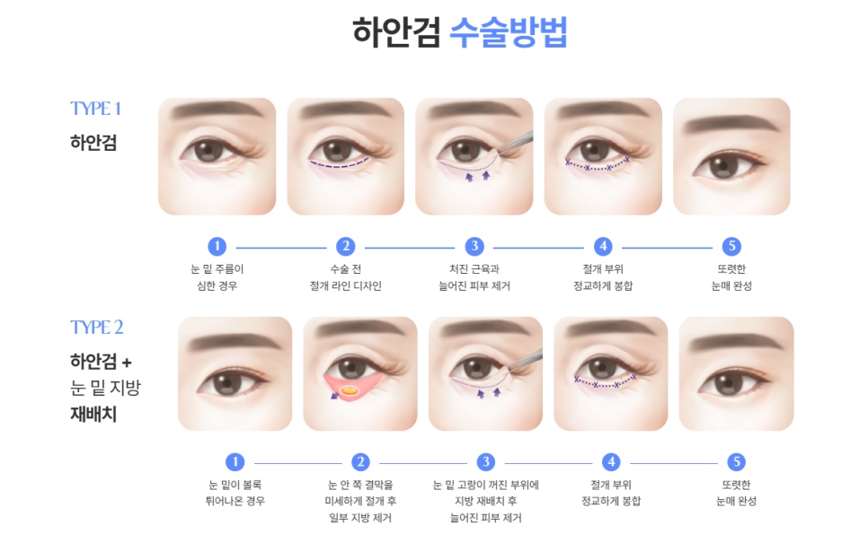 하안검수술흉터 연고, 울퉁불퉁한 눈 밑 흉터 걱정 없이 개선하는 방법 관련 이미지 6
