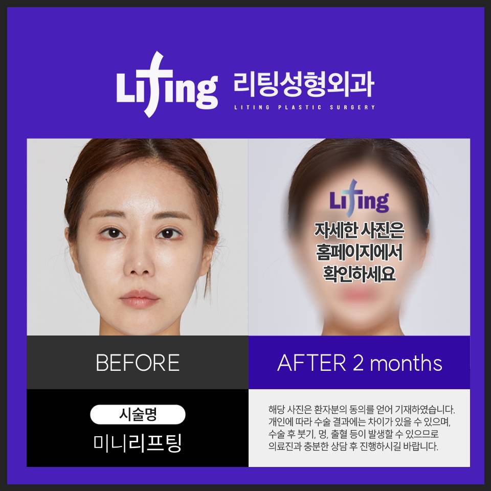 미니리프팅 비용, 정보 궁금하신 분들만 클릭하세요! 관련 이미지 5