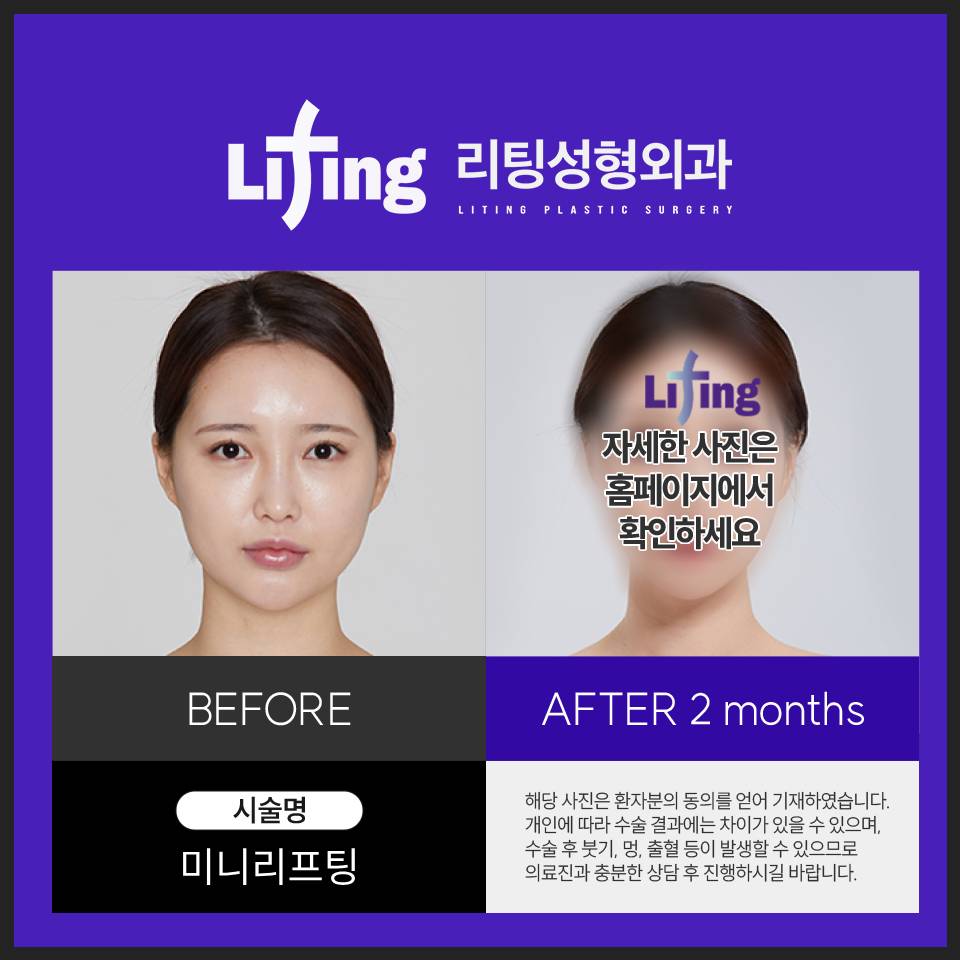 미니거상 효과, 유지기간? 궁금하신 점 전부 정리해 드립니다 관련 이미지 5