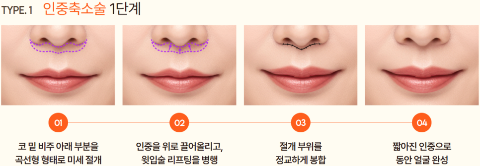 인중축소수술후기로 보는 얼굴 중심 비율의 재조정 ｜ 신사리프팅성형외과의 섬세한 접근 관련 이미지 8