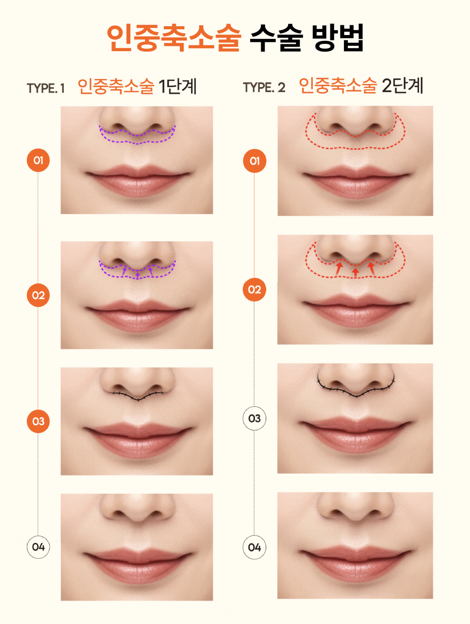 A Review of Upper Lip Reduction Surgery for a Long-Looking Face, and the Aesthetics of Midface Harmony Seen Through Facial Proportions image 8