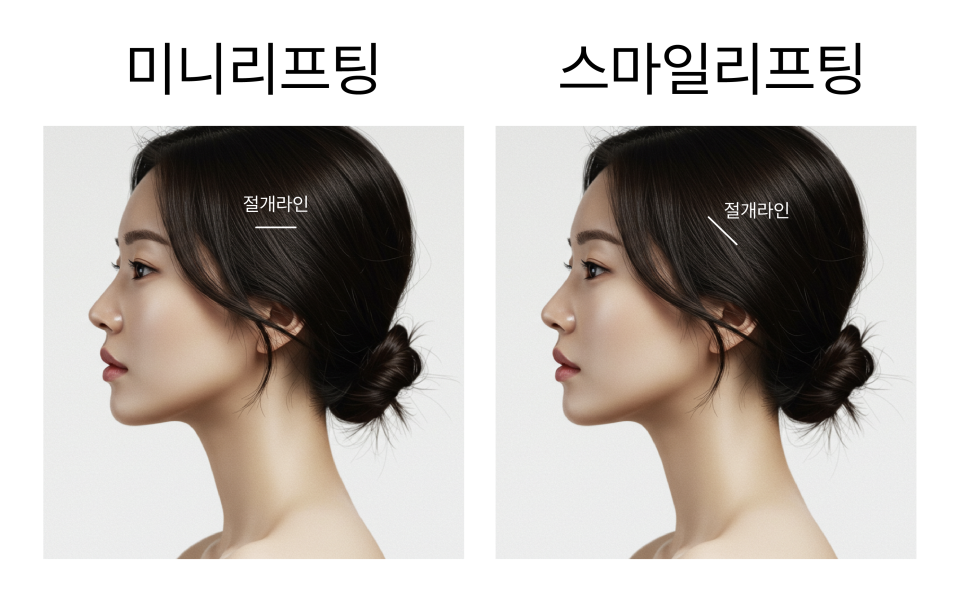 Smiley Lift, How to Improve Midface Sagging While Reducing Incision 부담｜Sinsa Lifting Plastic Surgery Clinic image 4