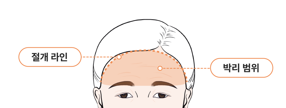 신사이마리프팅으로 달라지는 동안 한끗, 리프팅성형외과 전문의가 밝히는 결정적 차이 관련 이미지 9