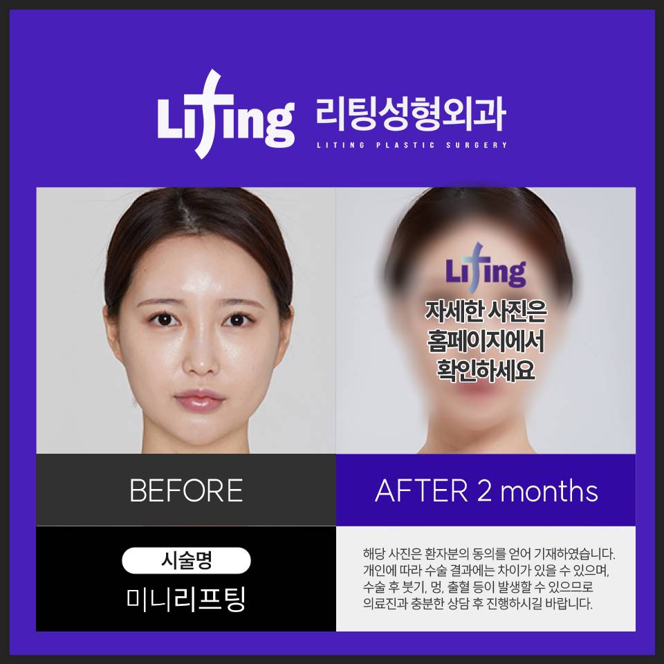 미니리프팅 비용, 정보 궁금하신 분들만 클릭하세요! 관련 이미지 4