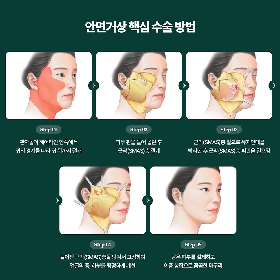 Considering a Facelift in Your 40s? Why Ligament Dissection Is Important at a Gangnam Lifting Clinic image 6