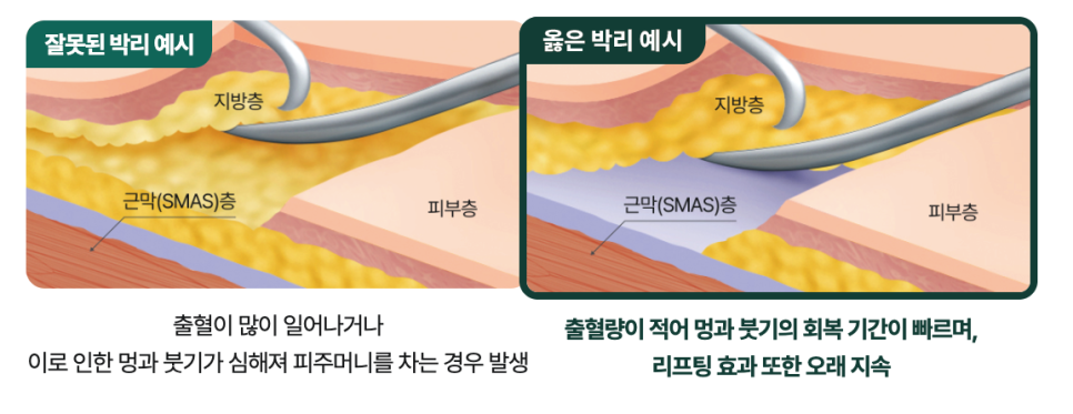 In Apgujeong plastic surgery, is revision lifting essential once the facelift maintenance period has passed? image 18