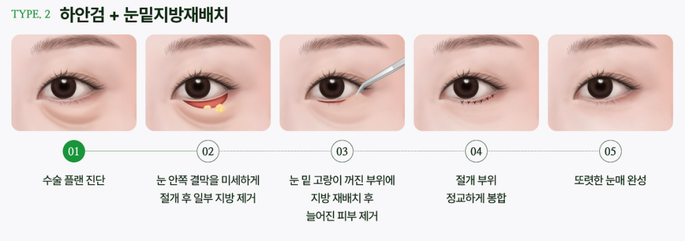 Sinsa Under-Eye Fat Repositioning: A Guide to Natural Under-Eye Changes from a Sinsa Lifting Dermatology Clinic image 12
