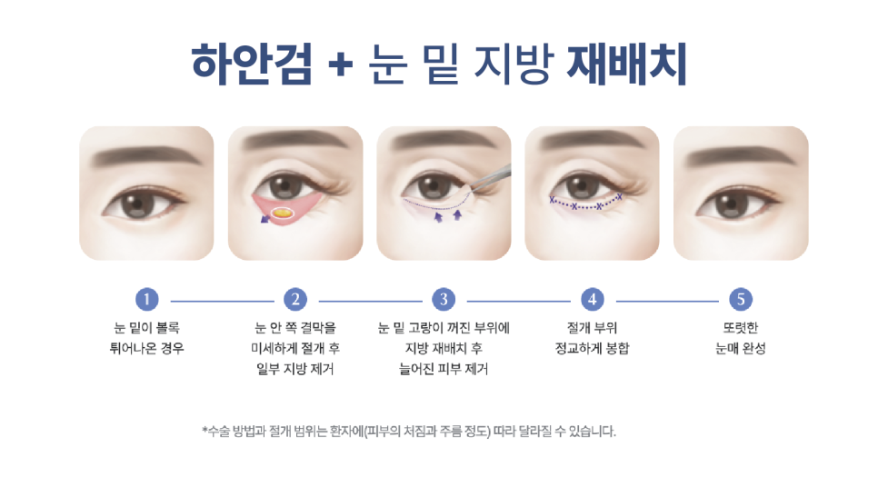 신사리프팅성형외과 눈밑지방재배치수술비용 궁금하다면? 하안검 수술과 비교해보세요 관련 이미지 9