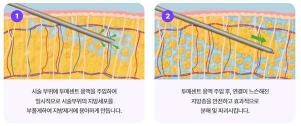 턱살리프팅, 강남역성형외과 여름다이어트 얼굴선 관리하는 법 관련 이미지 11