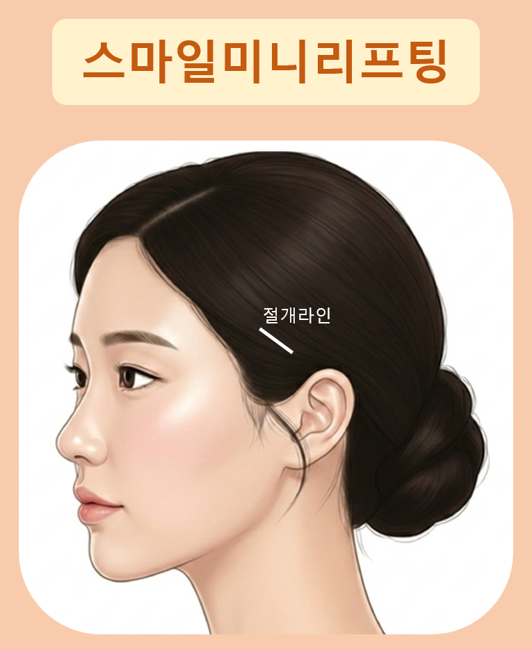 처진볼살리프팅후기에서 시작된 고민, 미니리프팅가격보다 중요한건 ‘방향’입니다 관련 이미지 10