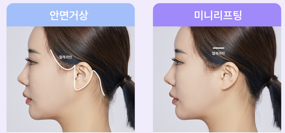 Facial Sagging Lift: Where to Start? Step-by-Step Elasticity Care Beginning with Apgujeong Thread Lifting image 11