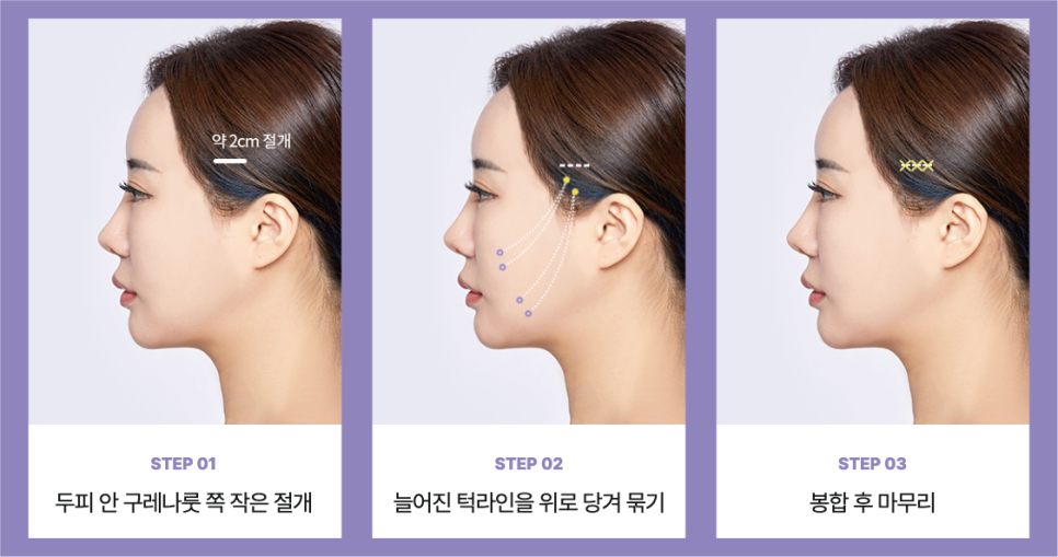 Why Is Mini Facelift Recovery Time in Gangnam Plastic Surgery Possible Over the Weekend? image 7