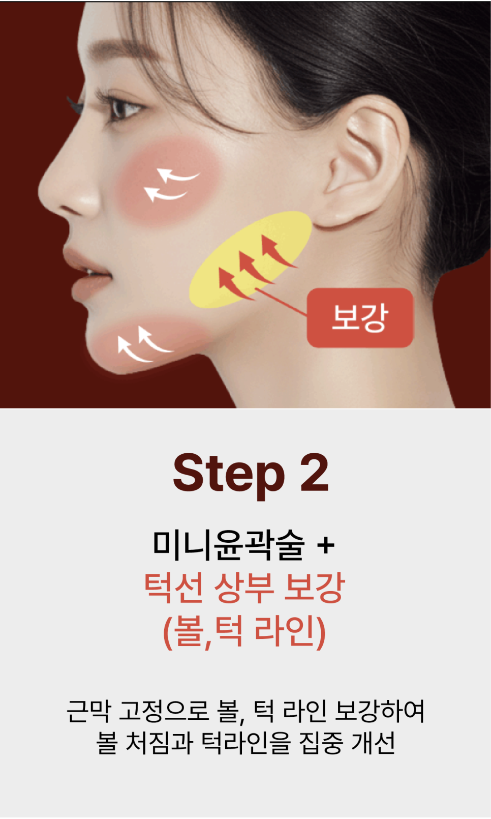 윤곽성형을 고민하게 되는 광대콤플렉스, 원인은 뼈만이 아닙니다 관련 이미지 13