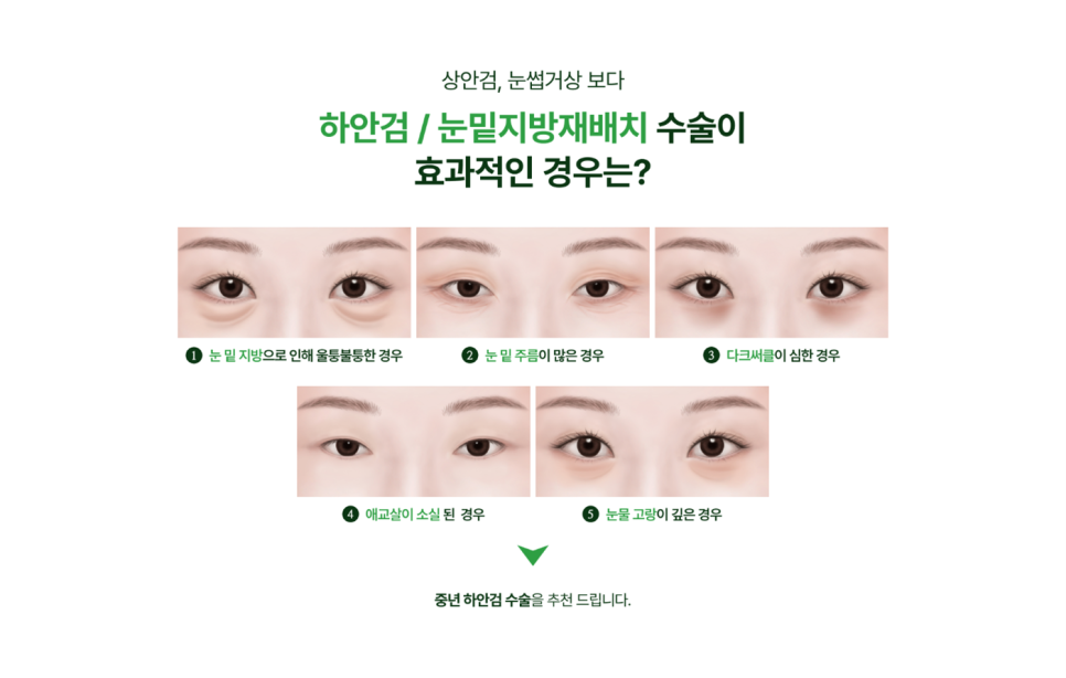청담성형외과 눈꺼풀 처짐 고민, 안검하수비용이 궁금하다면? 관련 이미지 10