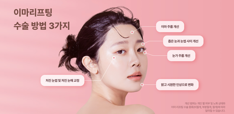 광주성형외과 이마리프팅으로 동안 인상되찾기 관련 이미지 8