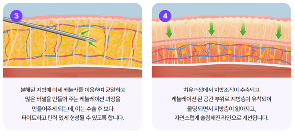턱살리프팅, 강남역성형외과 여름다이어트 얼굴선 관리하는 법 관련 이미지 12