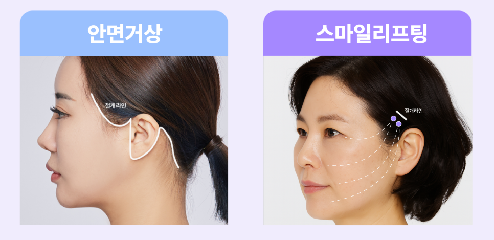 턱선리프팅 리팅미니리프팅 정보 (여름에 시너지나는 리프팅) 관련 이미지 4