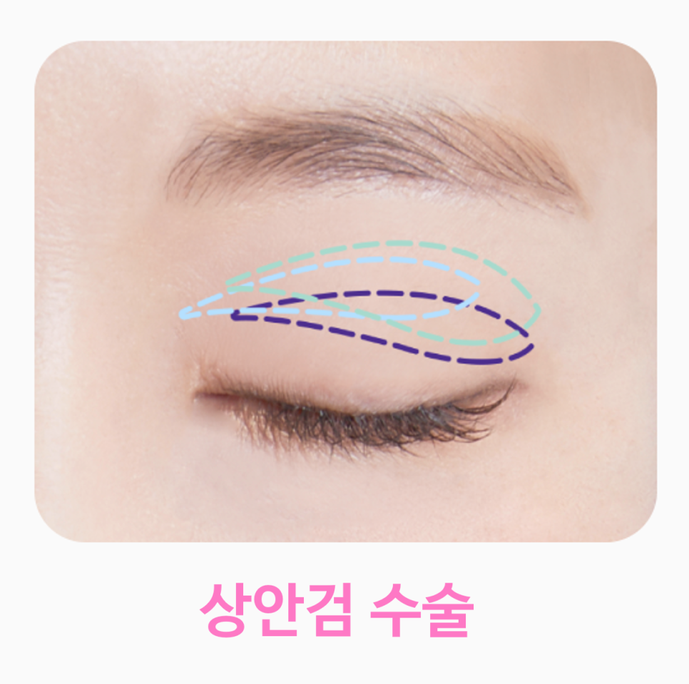 Smiley Lift, How to Improve Midface Sagging While Reducing Incision 부담｜Sinsa Lifting Plastic Surgery Clinic image 11