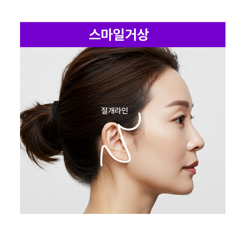 스마일리프팅가격 궁금하다면? 스마일거상과의 차이까지 한번에 정리 관련 이미지 10