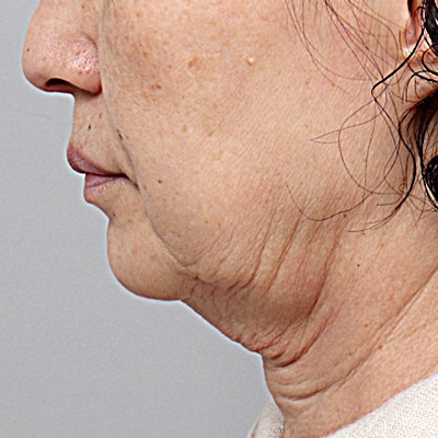 미니리프팅가격, 강남안면거상성형외과에서 보는 겨울 전 탄력 관리의 정밀 설계 관련 이미지 2