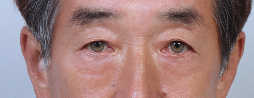 Understanding Gangnam Under-Eye Fat Repositioning, Causes of Hollow Under Eyes, and How the Structure Around the Eyes Changes with Age image 11