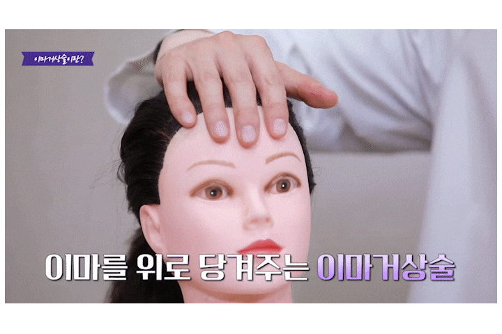Songpa Plastic Surgery Forehead Wrinkle Botox: The Real Reason It Didn’t Work for Me image 8